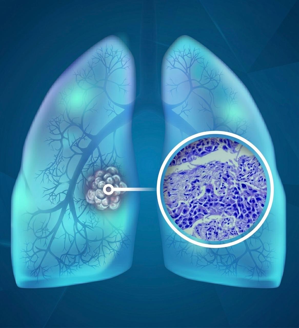 cáncer de pulmón células pequeñas 01