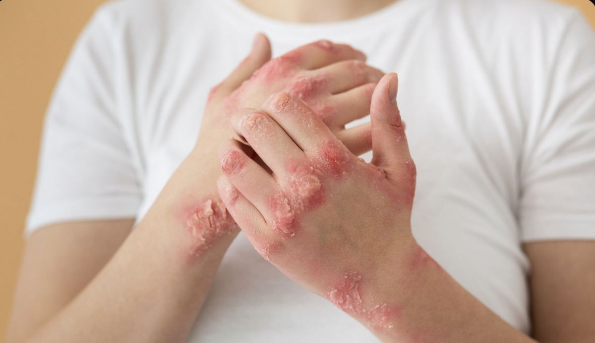 Depresión afecta hasta al 62% de los pacientes con psoriasis: especialistas urgen atención integral para mujeres en México Atención dermatológica integral y acompañamiento en salud emocional para mujeres con psoriasis en México